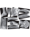 Rentgen (RTG) złamanych kośći