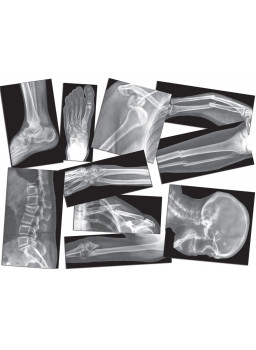 Rentgen (RTG) złamanych kośći